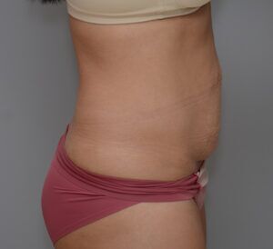 Abdominoplasty Before & After Patient #1442