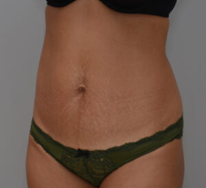 Abdominoplasty Before & After Patient #1441