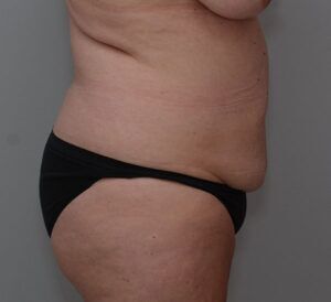 Abdominoplasty Before & After Patient #1444