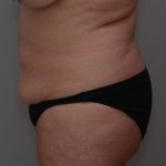 Liposuction with Bodytite Before & After Patient #1556