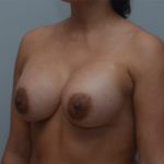 Breast Augmentation Before & After Patient #249