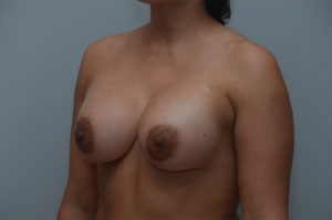 Breast Augmentation Before & After Patient #249