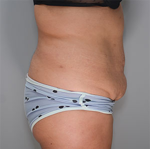 Abdominoplasty Before & After Patient #1273