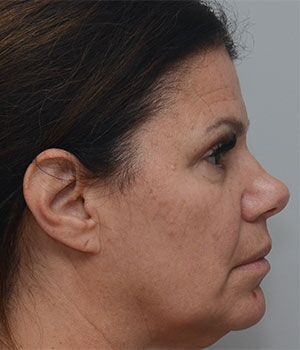 Laser Skin Resurfacing Before & After Patient #2230