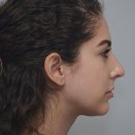 Rhinoplasty Before & After Patient #2114