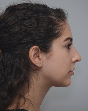 Rhinoplasty Before & After Patient #2114