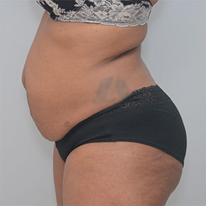 Abdominoplasty Before & After Patient #1384