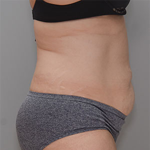 Abdominoplasty Before & After Patient #1383