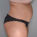 Abdominoplasty Before & After Patient #1329