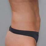 Abdominoplasty Before & After Patient #1328