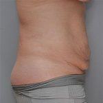 Abdominoplasty Before & After Patient #1272