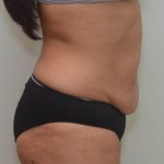 Abdominoplasty Before & After Patient #1386