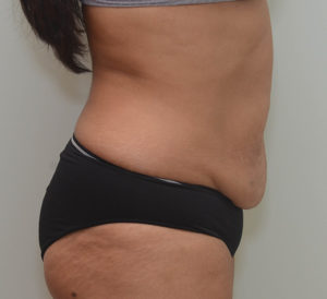 Abdominoplasty Before & After Patient #1386