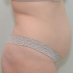 Abdominoplasty Before & After Patient #1385