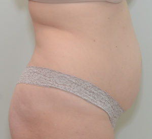 Abdominoplasty Before & After Patient #1385