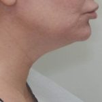 Neck Liposuction Before & After Patient #2003