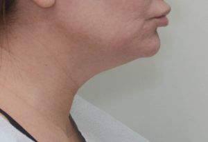 Neck Liposuction Before & After Patient #2003