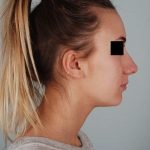 Rhinoplasty Before & After Patient #2113