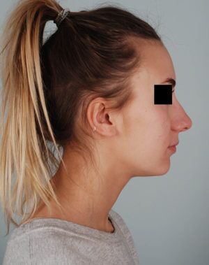 Rhinoplasty Before & After Patient #2113