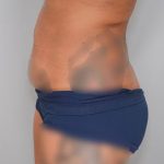 Abdominoplasty Before & After Patient #1269