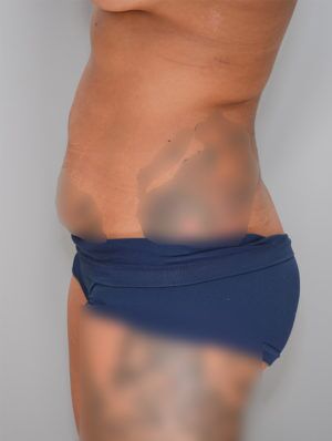 Abdominoplasty Before & After Patient #1269