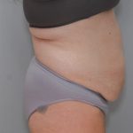 Abdominoplasty Before & After Patient #1211