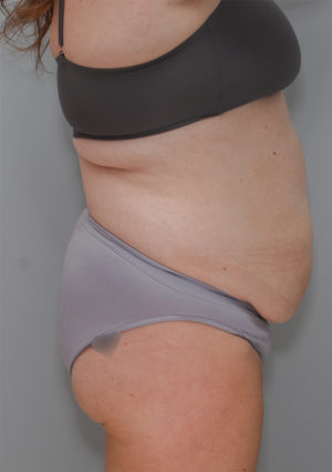 Abdominoplasty Before & After Patient #1211