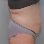 Liposuction Before & After Patient #1590