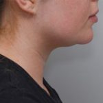 Neck Liposuction Before & After Patient #1949