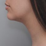 Neck Liposuction Before & After Patient #1948