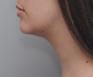 Neck Liposuction Before & After Patient #1948