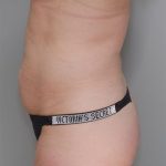 Liposuction with Bodytite Before & After Patient #1557