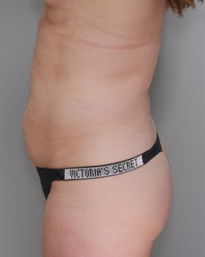 Liposuction Before & After Patient #1646