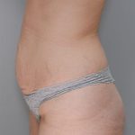 Abdominoplasty Before & After Patient #1270