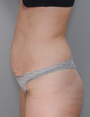 Abdominoplasty Before & After Patient #1270