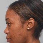 Non-Surgical Rhinoplasty Before & After Patient #2248