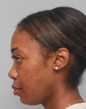 Non-Surgical Rhinoplasty Before & After Patient #2248