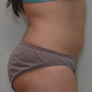 Liposuction Before & After Patient #1587