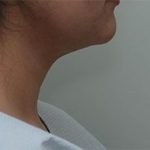 Neck Liposuction Before & After Patient #2004