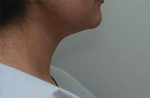 Neck Liposuction Before & After Patient #2004