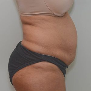 Abdominoplasty Before & After Patient #1207