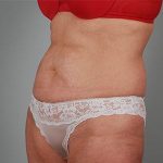 Abdominoplasty Before & After Patient #1209