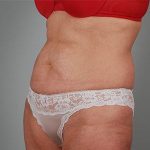 Abdominoplasty Before & After Patient #1588