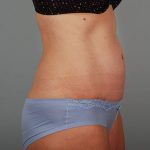 Abdominoplasty Before & After Patient #1330