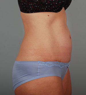 Abdominoplasty Before & After Patient #1330