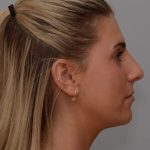 Rhinoplasty Before & After Patient #2115