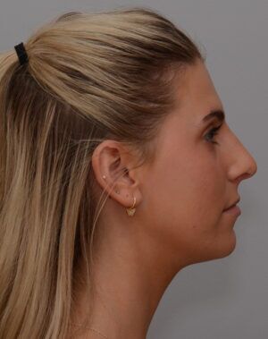 Rhinoplasty Before & After Patient #2115