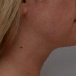 Neck Liposuction Before & After Patient #2008