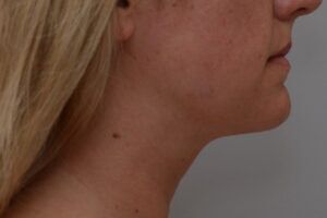 Neck Liposuction Before & After Patient #2008