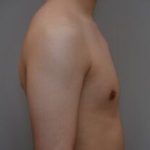 Gynecomastia Before & After Patient #1160